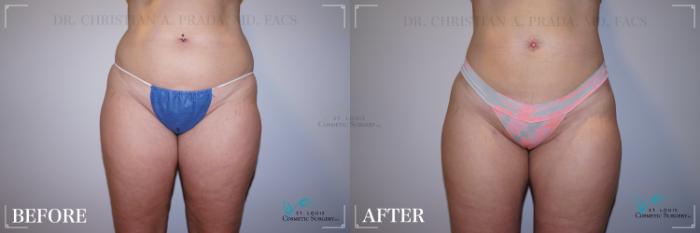 Before & After Liposuction Case 225 Front View in St. Louis, MO