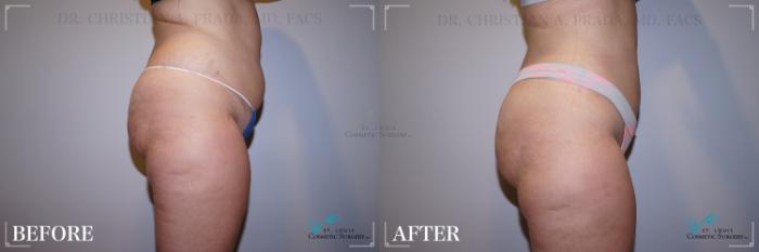 Before & After Liposuction Case 225 Right Side View in St. Louis, MO