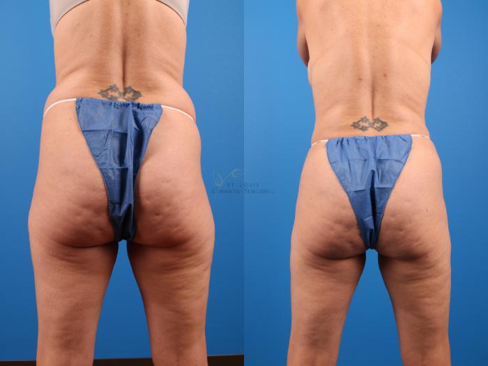 Before & After Liposuction Case 284 Front View in St. Louis, MO
