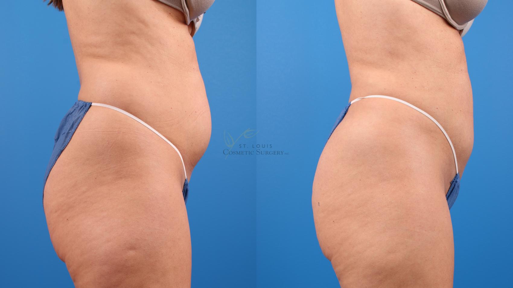 right oblique and back view of liposuction by Dr. Herluf Lund