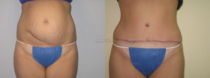 Before & After Liposuction Case 3 View #1 View in St. Louis, MO