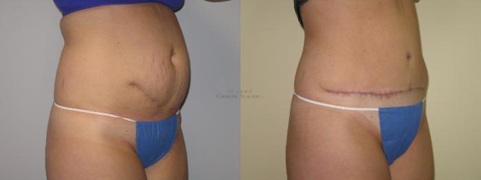 Before & After Liposuction Case 3 View #2 View in St. Louis, MO