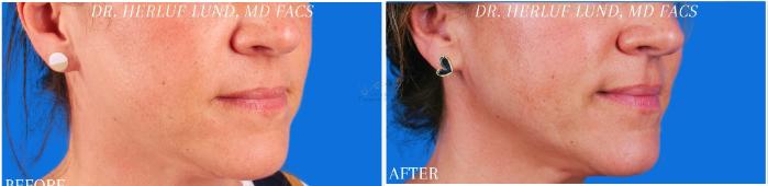 Before & After Neck Lift Case 378 Left Oblique View in St. Louis, MO