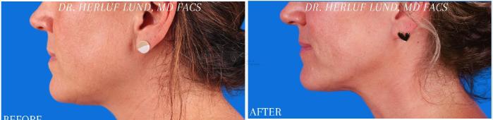 Before & After Neck Lift Case 378 Right Side View in St. Louis, MO