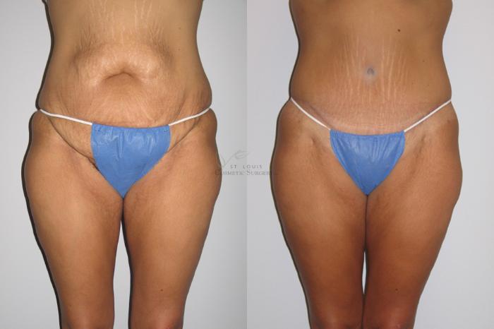 Before & After Liposuction Case 6 View #1 View in St. Louis, MO