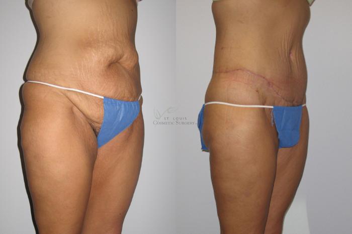 Before & After Liposuction Case 6 View #2 View in St. Louis, MO
