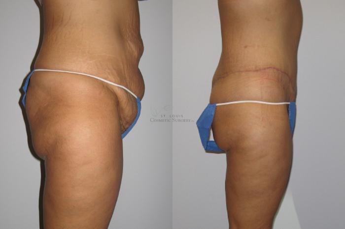 Before & After Liposuction Case 6 View #3 View in St. Louis, MO