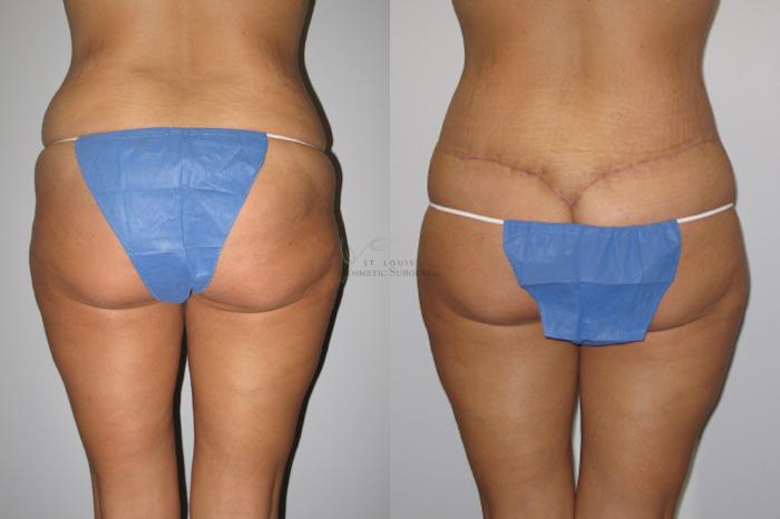 Before & After Liposuction Case 6 View #4 View in St. Louis, MO