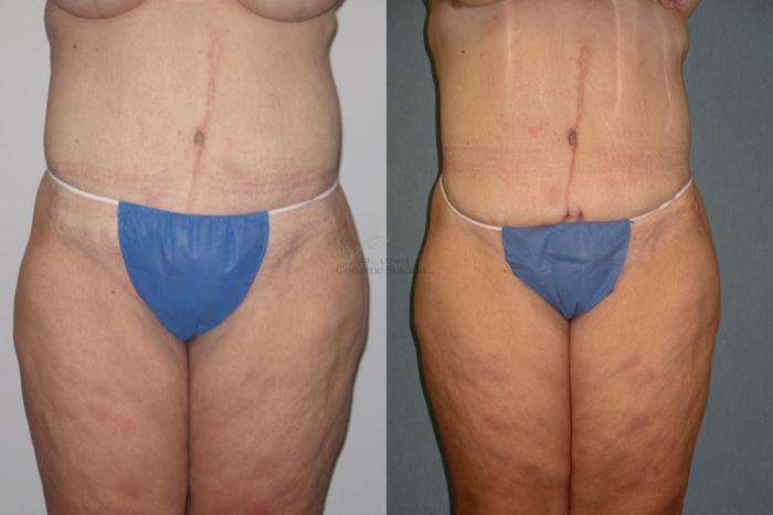 Before & After Liposuction Case 8 View #1 View in St. Louis, MO