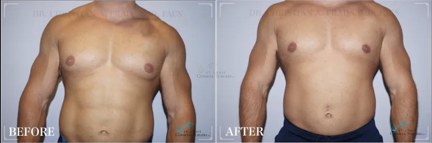 Before & After Male Breast Reduction Case 308 View #1 View in St. Louis, MO