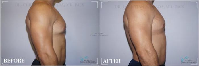 Before & After Male Breast Reduction Case 308 View #2 View in St. Louis, MO