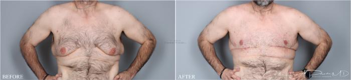 Before & After Male Breast Reduction Case 391 Front View in St. Louis, MO