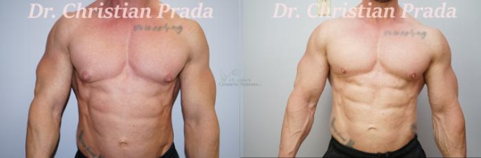 Before & After Male Breast Reduction Case 392 Front View in St. Louis, MO