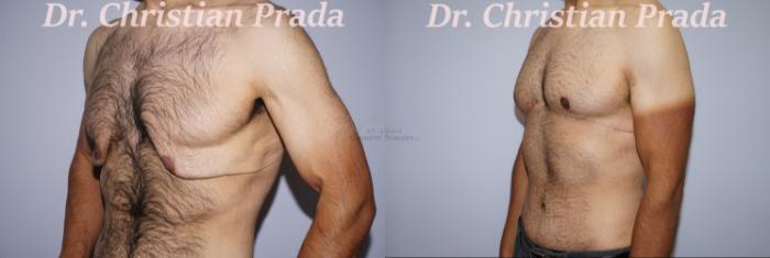 Before & After Male Breast Reduction Case 393 Right Oblique View in St. Louis, MO