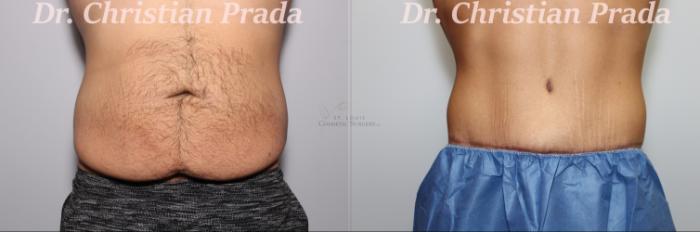 Before & After Male Breast Reduction Case 394 Abdominoplasty Front View in St. Louis, MO