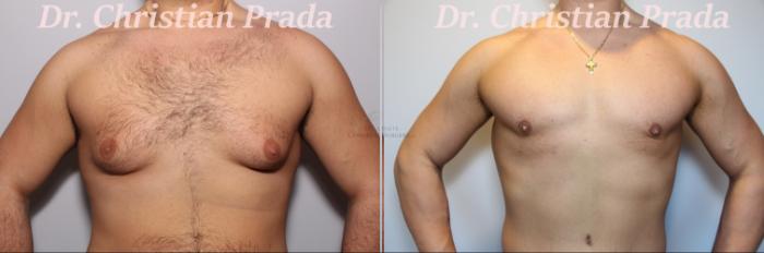 Before & After Male Breast Reduction Case 394 Front View in St. Louis, MO