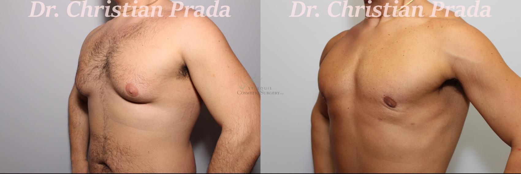 Before & After Male Breast Reduction Case 394 Right Oblique View in St. Louis, MO