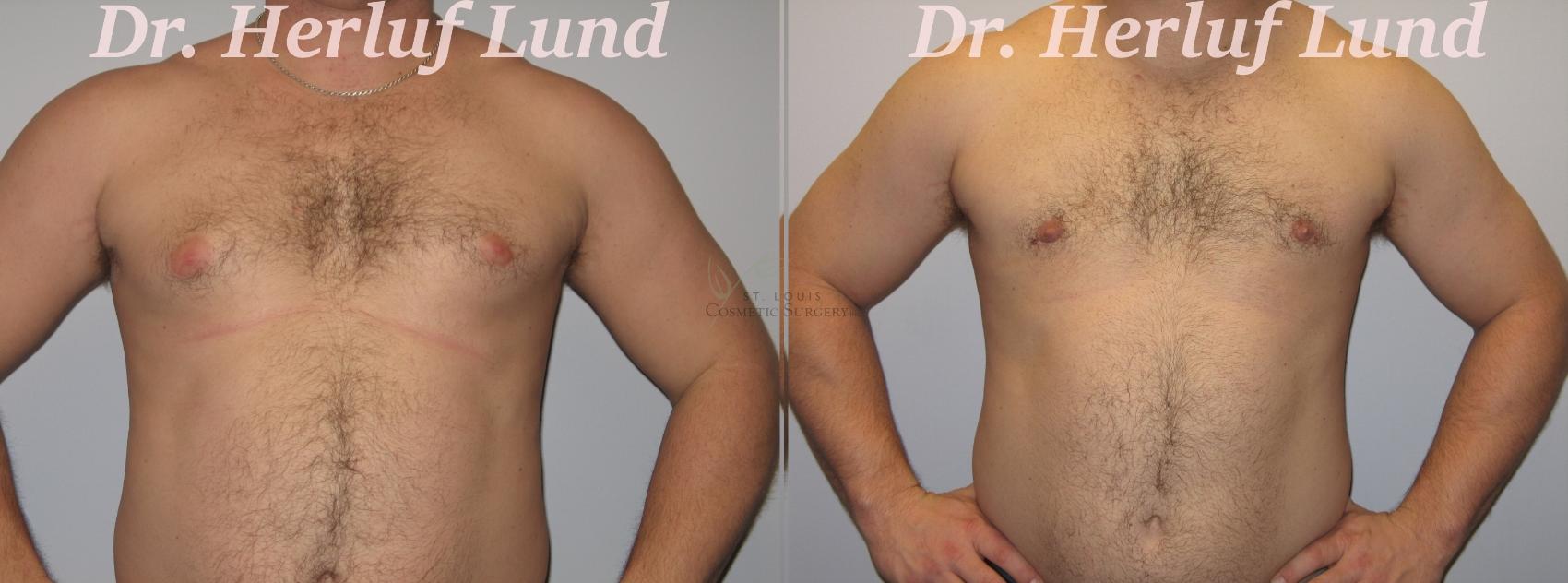 Before & After Male Breast Reduction Case 395 Front View in St. Louis, MO