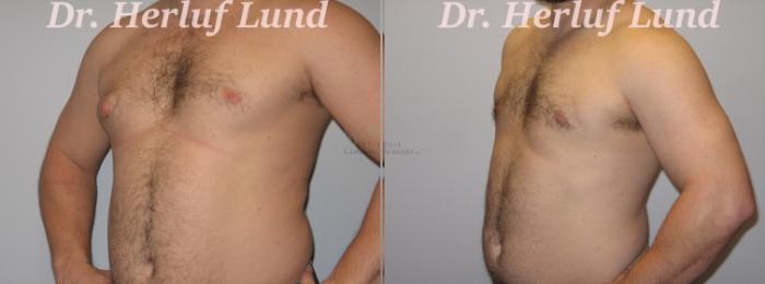 Before & After Male Breast Reduction Case 395 Right Oblique View in St. Louis, MO