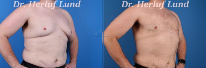 Before & After Male Breast Reduction Case 396 Left Oblique View in St. Louis, MO