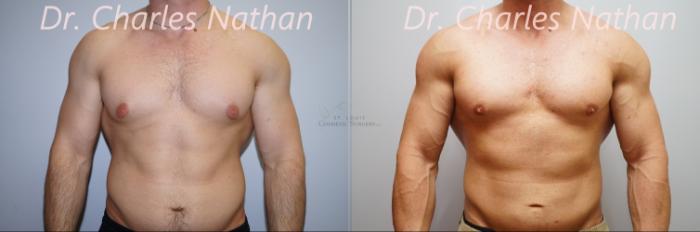 Before & After Male Breast Reduction Case 397 Front View in St. Louis, MO