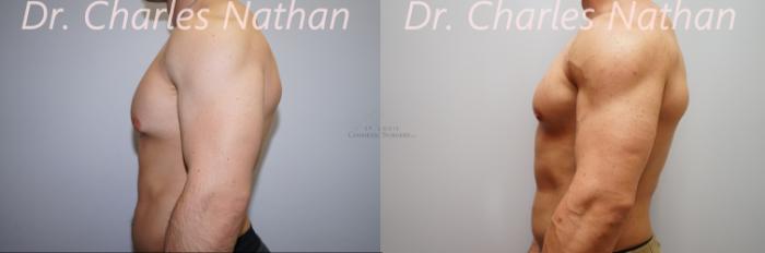 Before & After Male Breast Reduction Case 397 Right Side View in St. Louis, MO