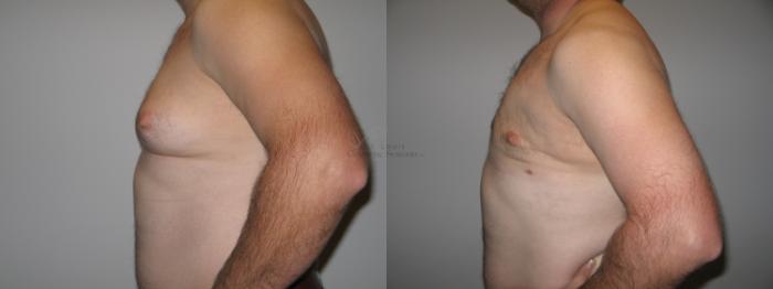 Before & After Male Breast Reduction Case 44 View #1 View in St. Louis, MO