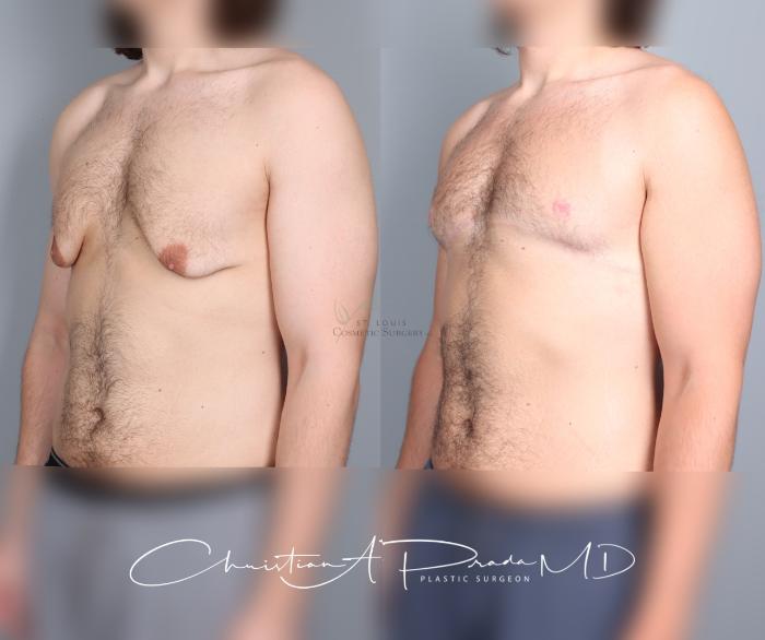 Before & After Male Breast Reduction Case 458 Left Oblique View in St. Louis, MO