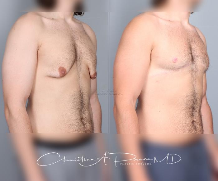 Before & After Male Breast Reduction Case 458 Right Oblique View in St. Louis, MO