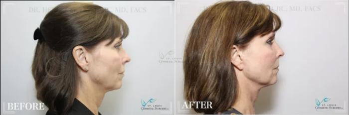 Before & After Mini Facelift Case 307 View #3 View in St. Louis, MO