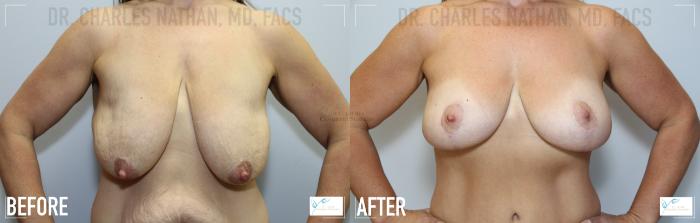 Before & After Breast Lift Case 109 Front- Breasts View in St. Louis, MO