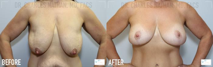 Before & After Breast Lift Case 109 Front View in St. Louis, MO