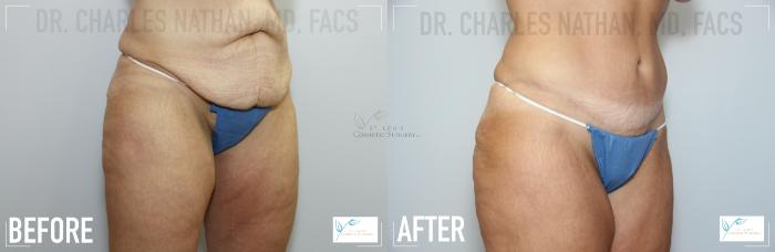 Before & After Breast Lift Case 109 Left Oblique View in St. Louis, MO