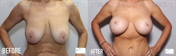 Before & After Breast Lift Case 112 Front- Breast View in St. Louis, MO