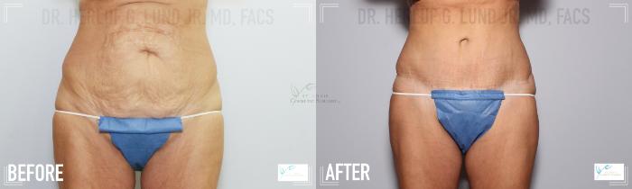Before & After Breast Augmentation Case 112 Front- Tummy Tuck View in St. Louis, MO