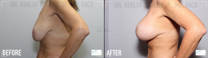 Before & After Breast Lift Case 112 Left- Breast View in St. Louis, MO