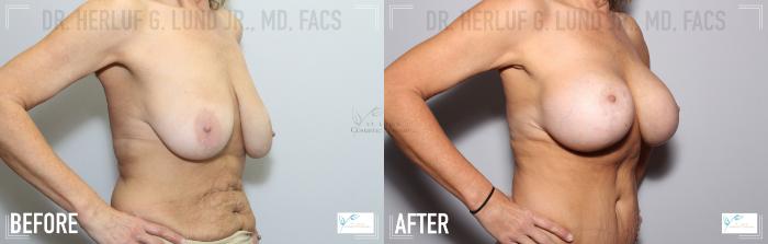 Before & After Breast Augmentation Case 112 Right Oblique View in St. Louis, MO