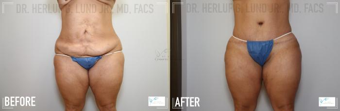 Before & After Breast Lift Case 122 Front- Abdomen  View in St. Louis, MO
