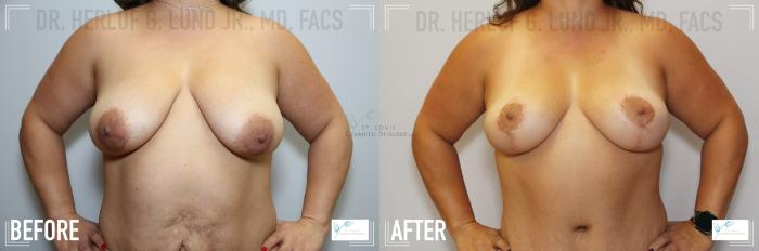 Before & After Tummy Tuck Case 122 Front-Breast View in St. Louis, MO