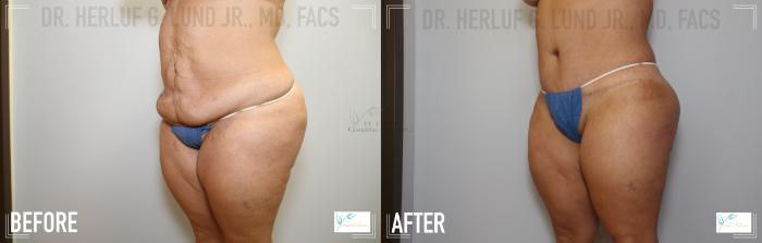 Before & After Mommy Makeover Case 122 Left Oblique- Abdomen  View in St. Louis, MO