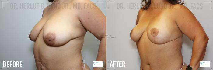 Before & After Breast Lift Case 122 Left Oblique- Breasts View in St. Louis, MO