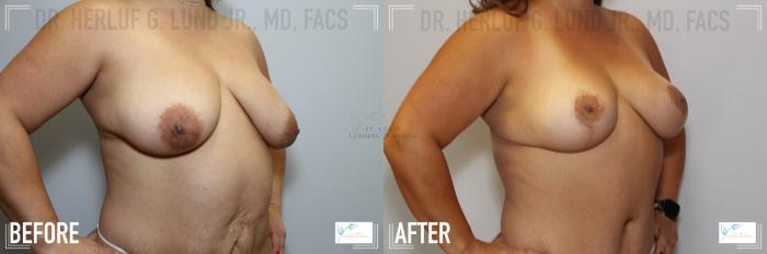 Before & After Mommy Makeover Case 122 Right Oblique-Breasts View in St. Louis, MO
