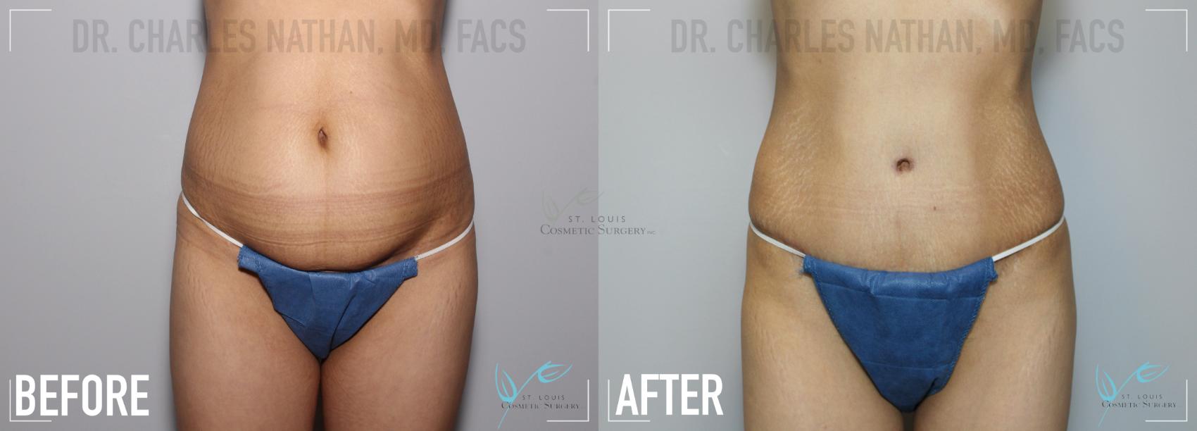 Before & After Tummy Tuck Case 133 Front- Abdominoplasty View in St. Louis, MO