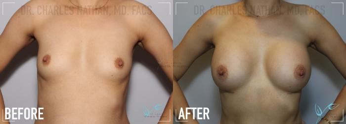 Before & After Tummy Tuck Case 133 Front- Breast Augmentation View in St. Louis, MO