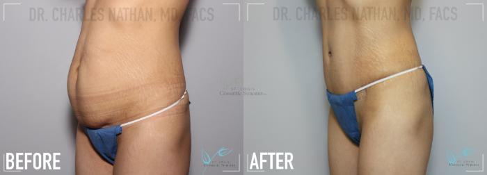 Before & After Tummy Tuck Case 133 Left Oblique- Abdominoplasty View in St. Louis, MO