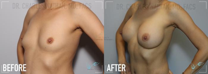Before & After Tummy Tuck Case 133 Left Oblique- Breast Augmentation View in St. Louis, MO