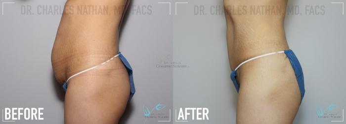 Before & After Mommy Makeover Case 133 Left Side- Abdominoplasty View in St. Louis, MO