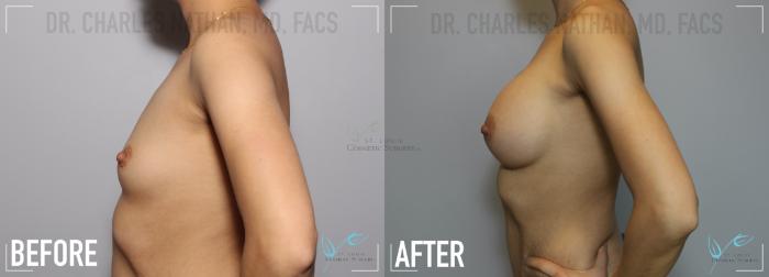 Before & After Breast Augmentation Case 133 Left Side- Breast Augmentation View in St. Louis, MO