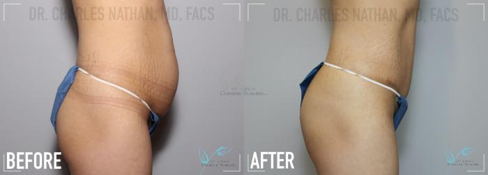 Before & After Breast Augmentation Case 133 Ride Side- Abdominoplasty View in St. Louis, MO