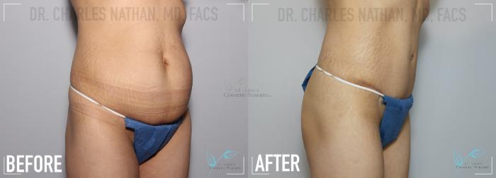 Before & After Breast Augmentation Case 133 Right Oblique- Abdominoplasty View in St. Louis, MO